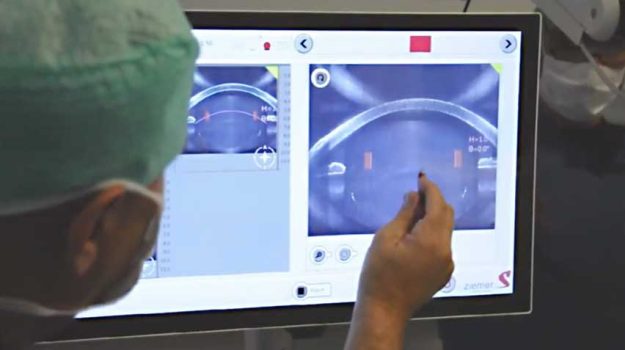 laser-femto cataratta, oculista Marzio Vanzini Bologna, operazione cataratta laser, specialista in chirurgia Laser
