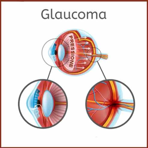 illustrazione-glaucoma glaucoma diagnosi precoce, cure glaucoma, sintomi glaucoma, dr Marzio Vanzini